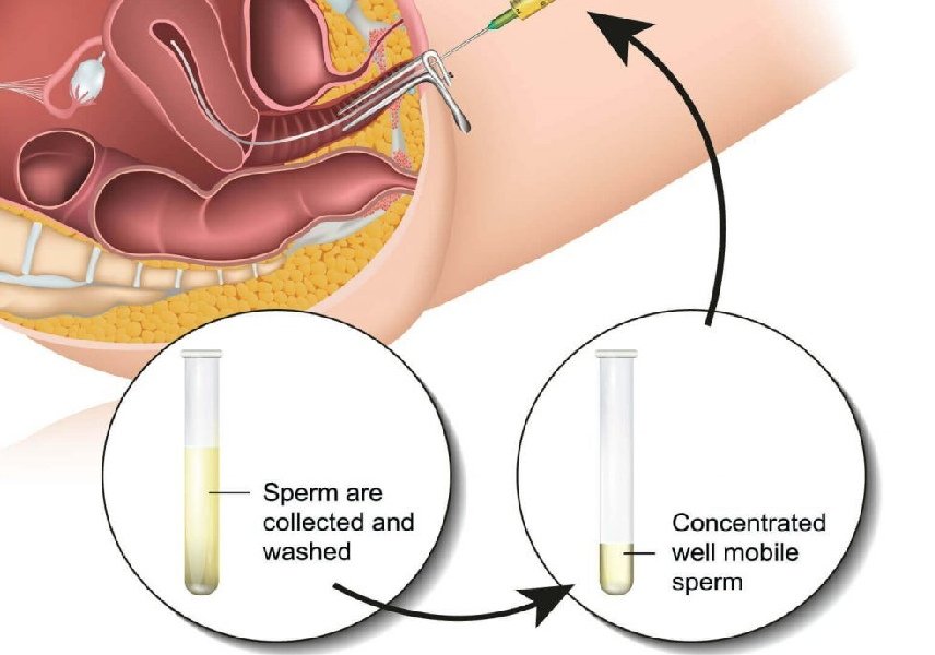 IUI Treatment in Gurgaon